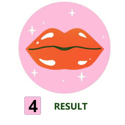 result lip filer in beauty cilinic - نتيجة حقن الشفاه في عيادة التجميل