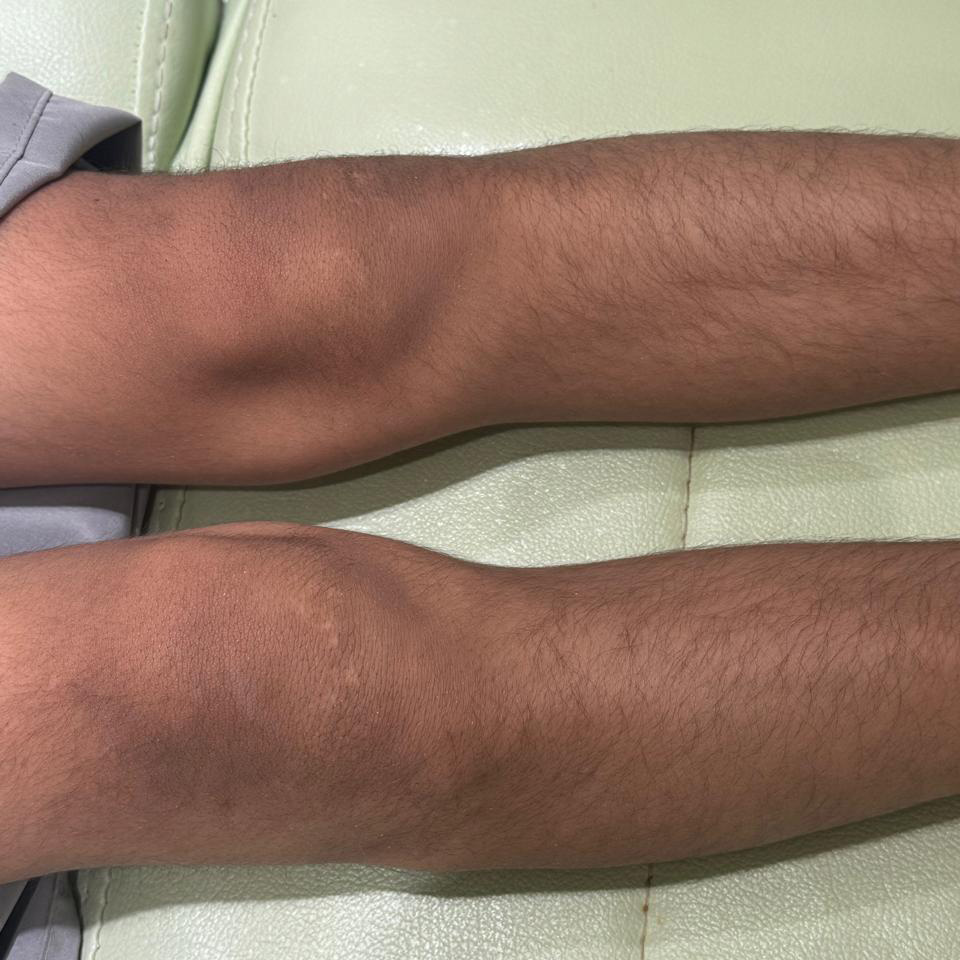 Vitiligo on the feet in oman