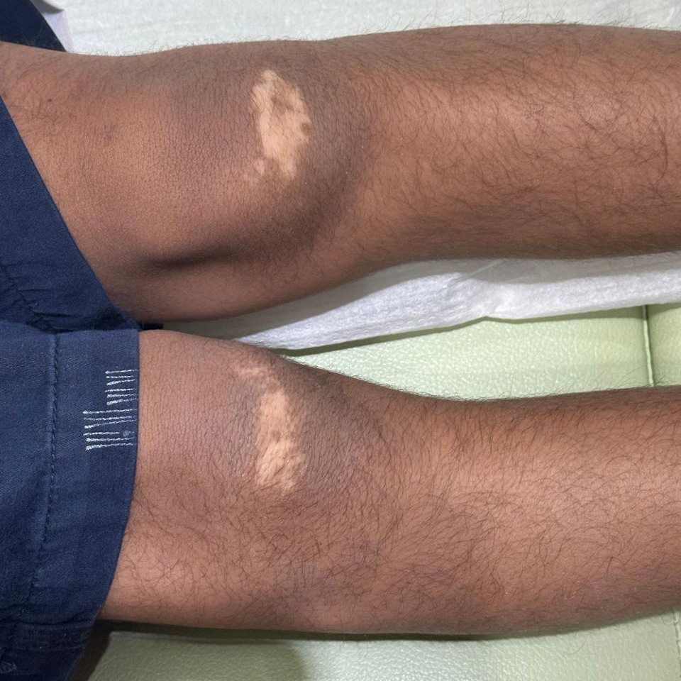 Vitiligo on the feet in oman