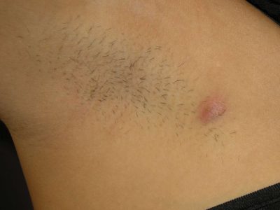 what do underarm pimples indicate