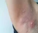 what do underarm pimples indicate
