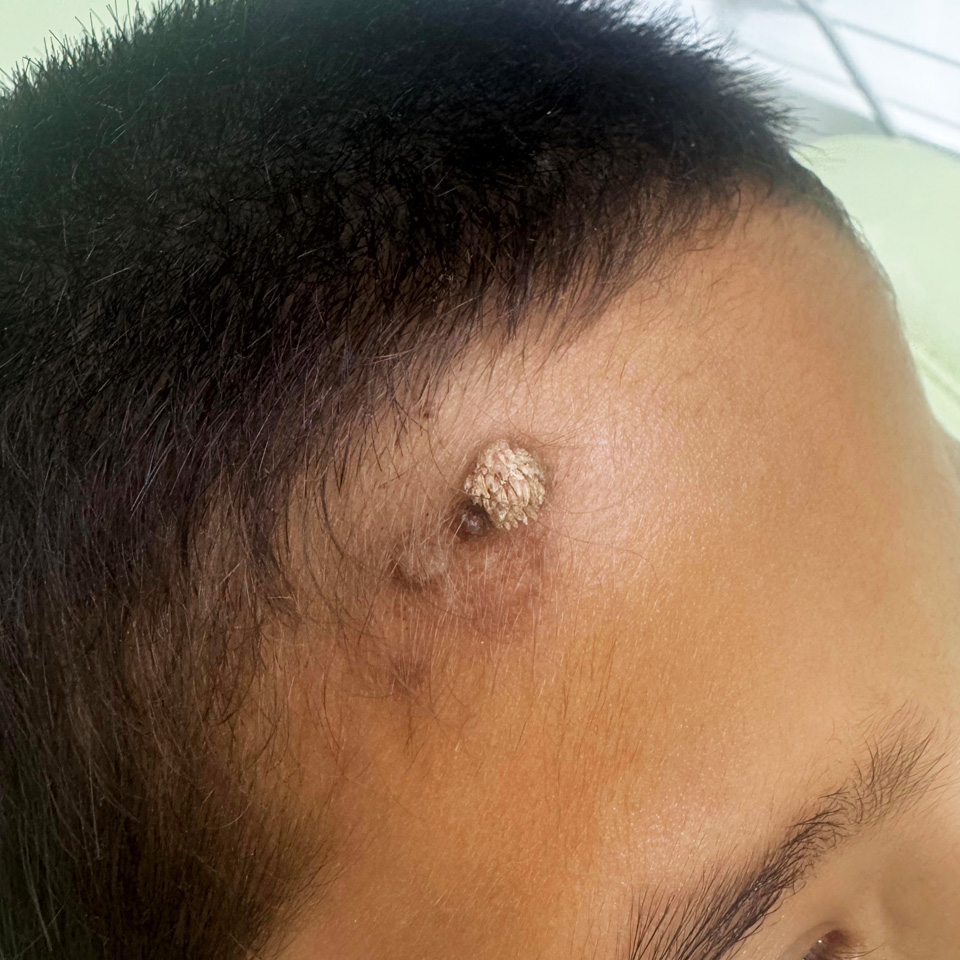 before wart removal treatment at the muscat and sohar