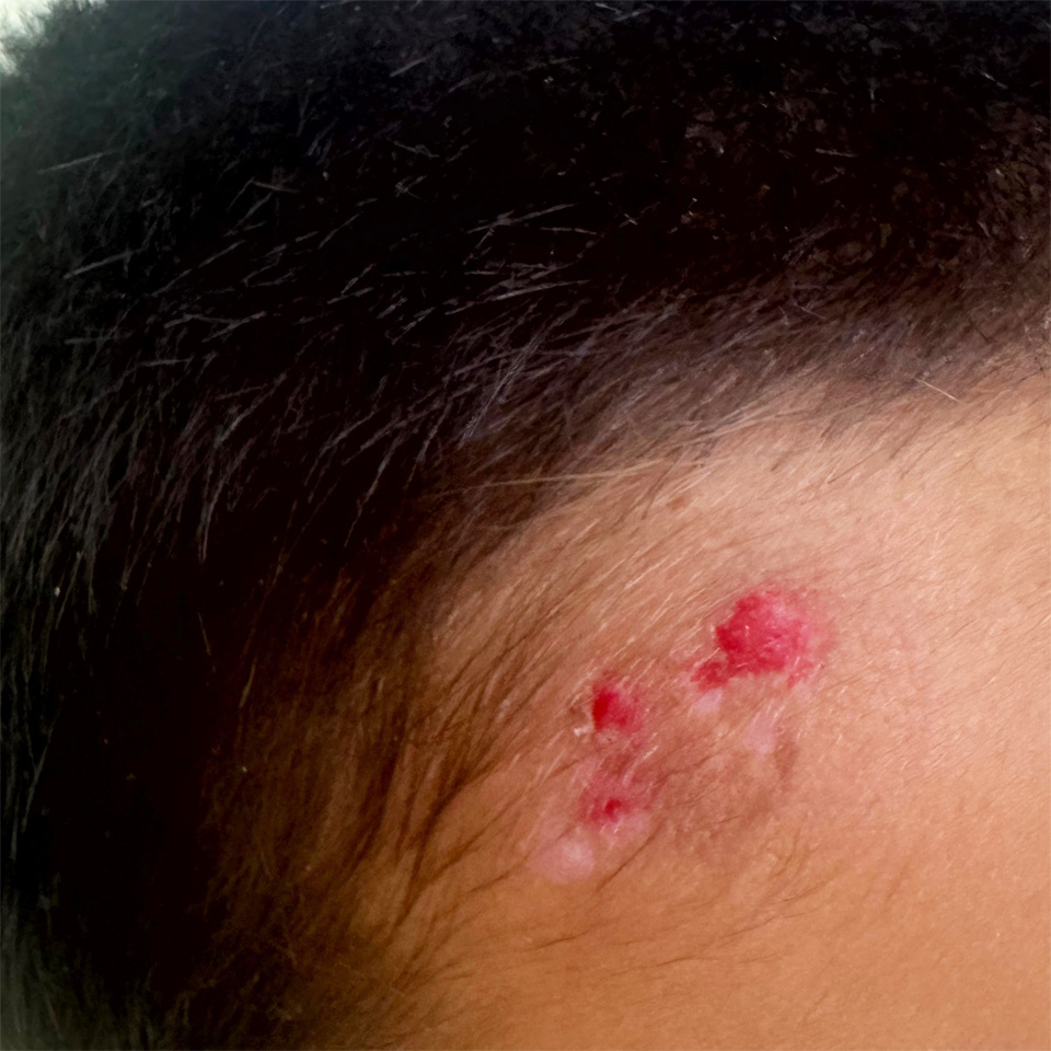 after wart removal treatment at the muscat and sohar