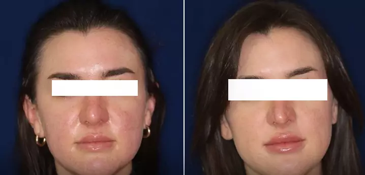 Nasal Swelling After Rhinoplasty (Cosmetic Nose Surgery)